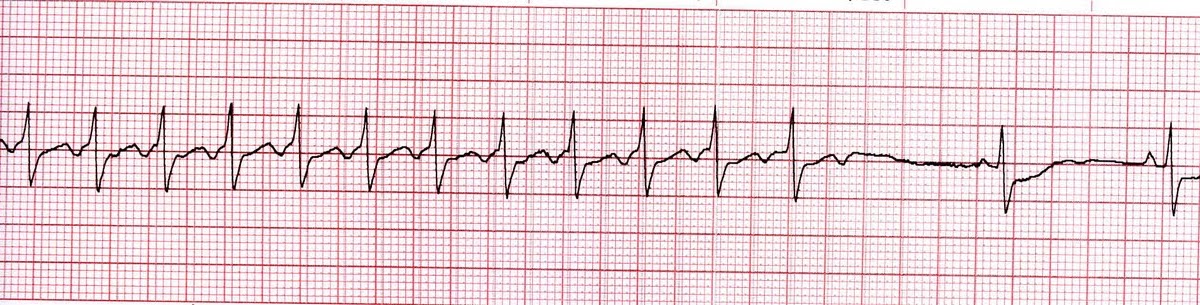 Psvt / : Maneuvers and drugs to slow heart rate or restore a normal rhythm.